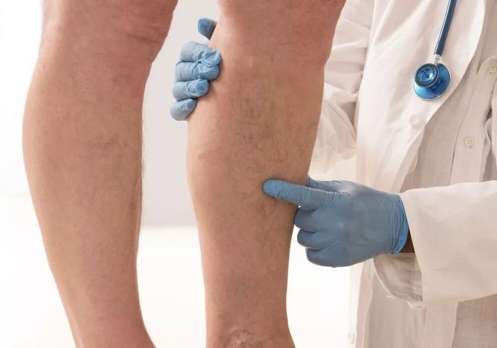 Tratamento de varices