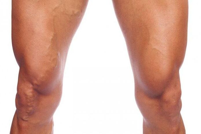varices